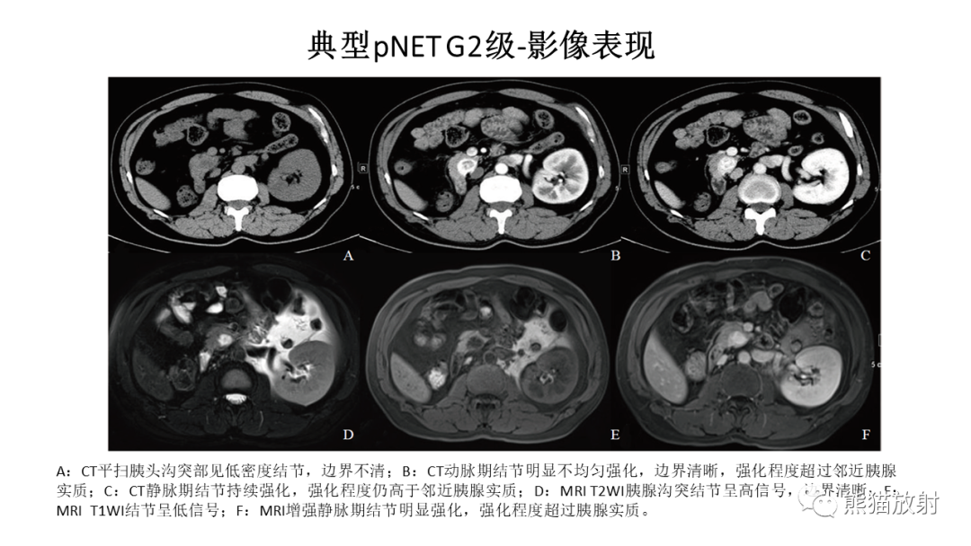 影像PPT - 【病例】胰腺神经内分泌肿瘤2例CT及MR影像-26