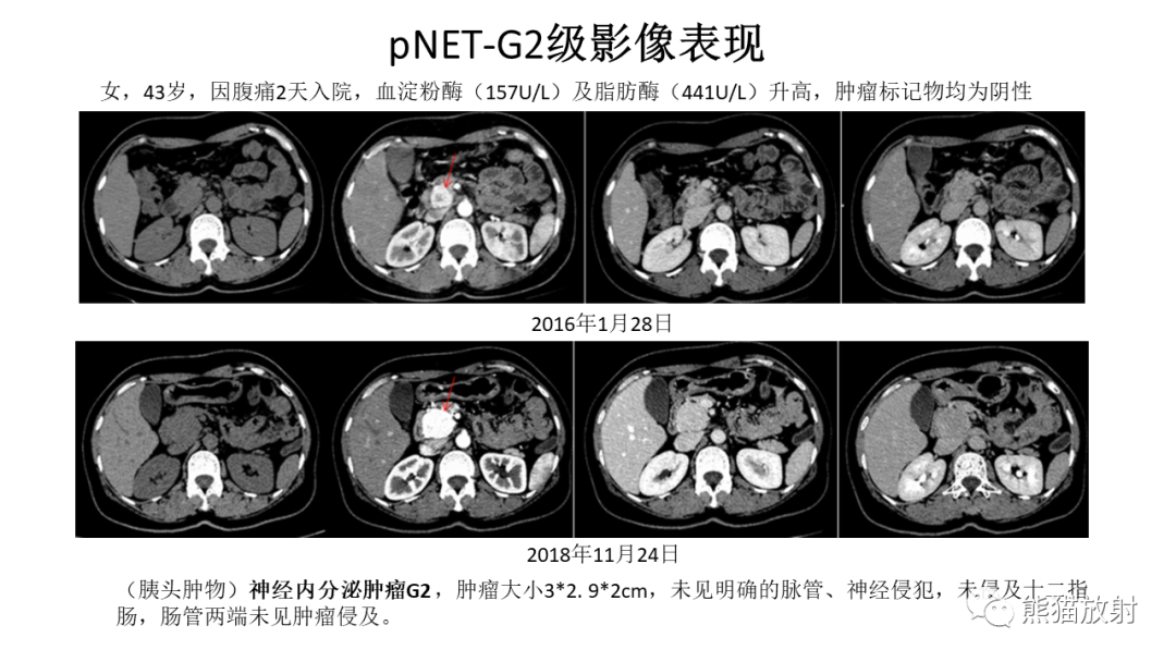 影像PPT - 【病例】胰腺神经内分泌肿瘤2例CT及MR影像-27