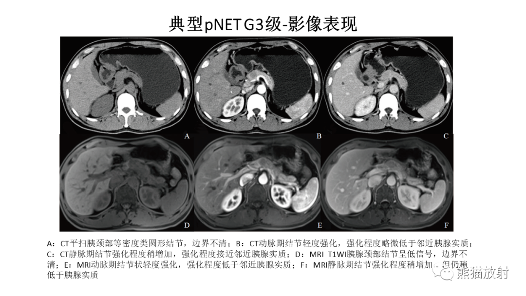 影像PPT - 【病例】胰腺神经内分泌肿瘤2例CT及MR影像-28