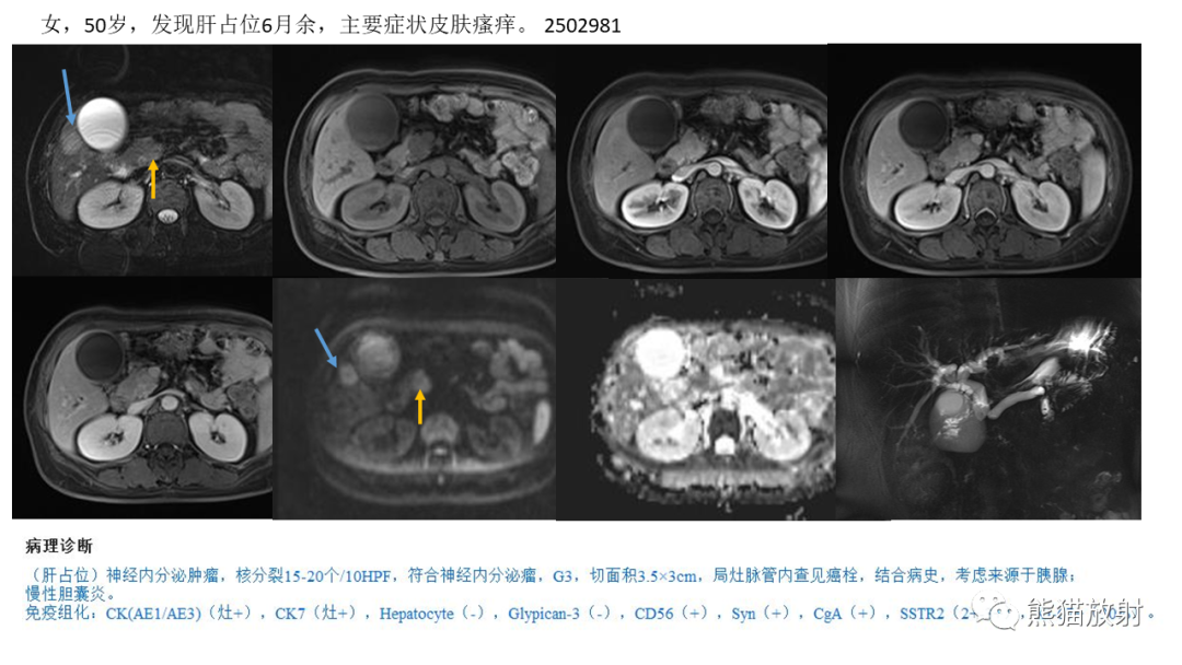 影像PPT - 【病例】胰腺神经内分泌肿瘤2例CT及MR影像-29