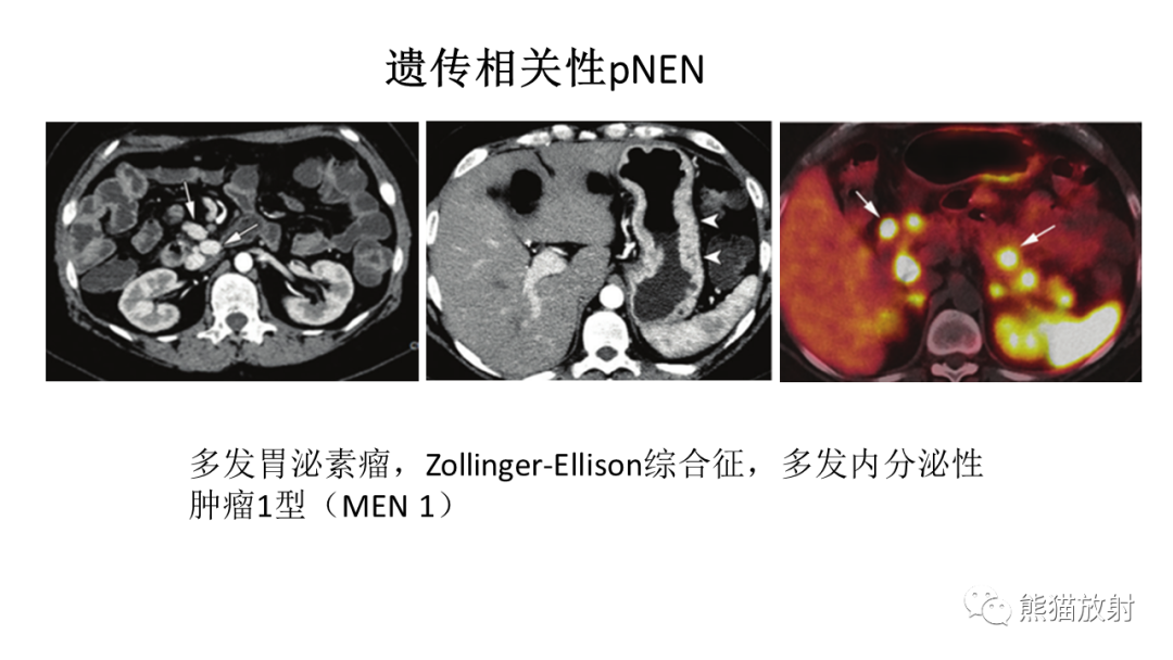 影像PPT - 【病例】胰腺神经内分泌肿瘤2例CT及MR影像-30