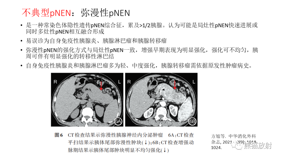影像PPT - 【病例】胰腺神经内分泌肿瘤2例CT及MR影像-31