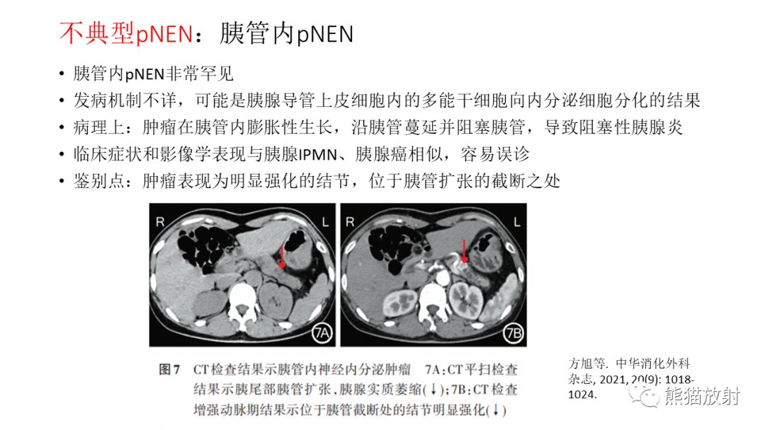 影像PPT - 【病例】胰腺神经内分泌肿瘤2例CT及MR影像-32