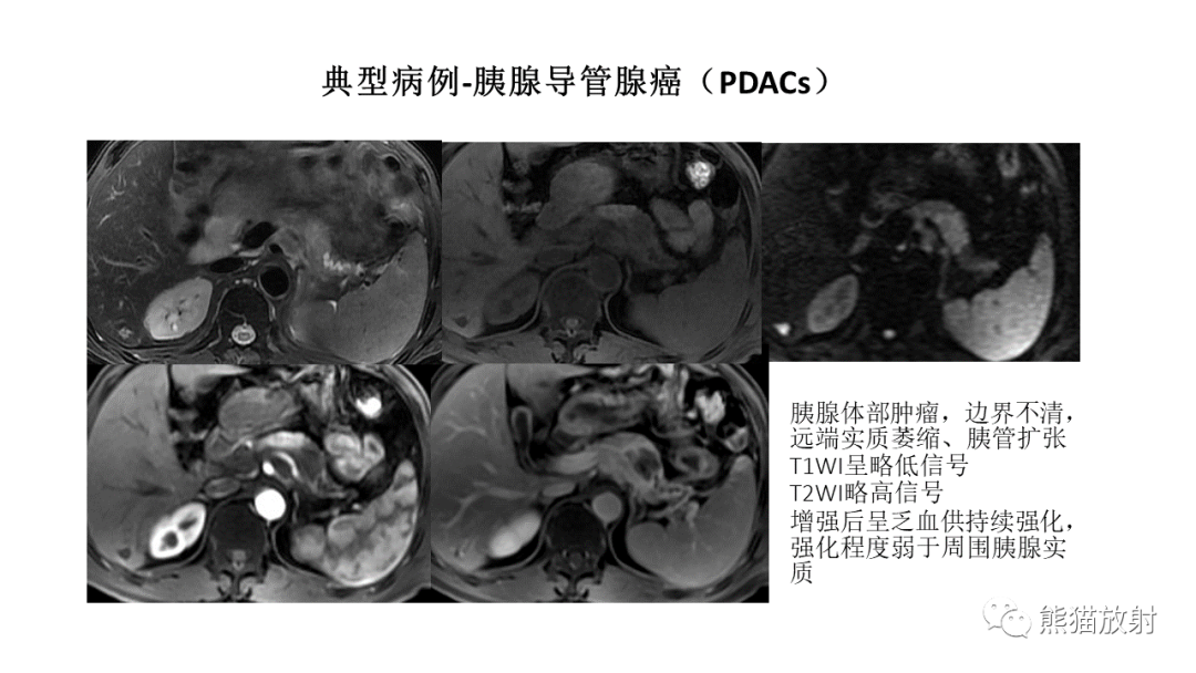 影像PPT - 【病例】胰腺神经内分泌肿瘤2例CT及MR影像-35