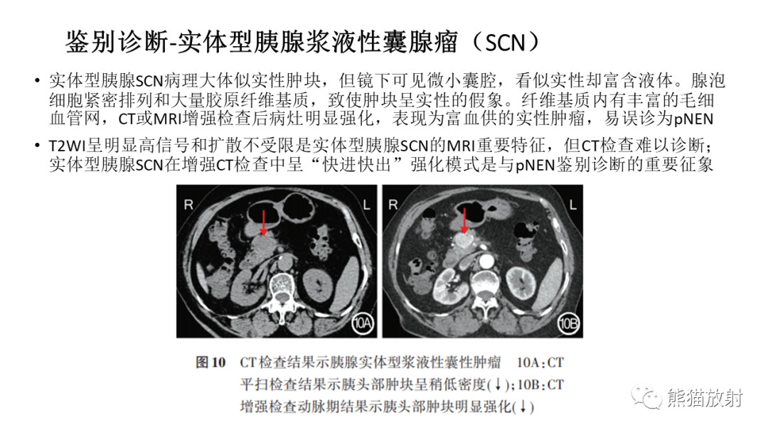 影像PPT - 【病例】胰腺神经内分泌肿瘤2例CT及MR影像-36