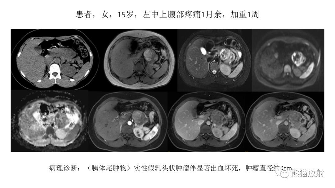 影像PPT - 【病例】胰腺神经内分泌肿瘤2例CT及MR影像-38