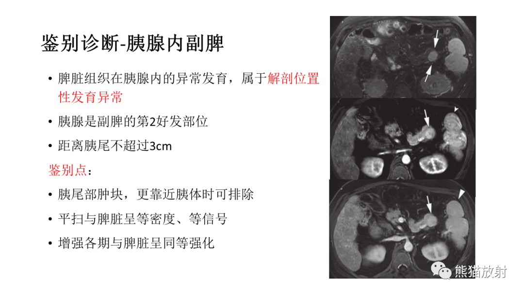 影像PPT - 【病例】胰腺神经内分泌肿瘤2例CT及MR影像-39