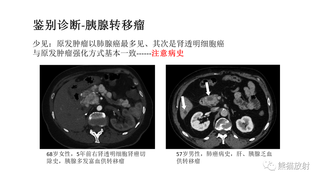 影像PPT - 【病例】胰腺神经内分泌肿瘤2例CT及MR影像-40