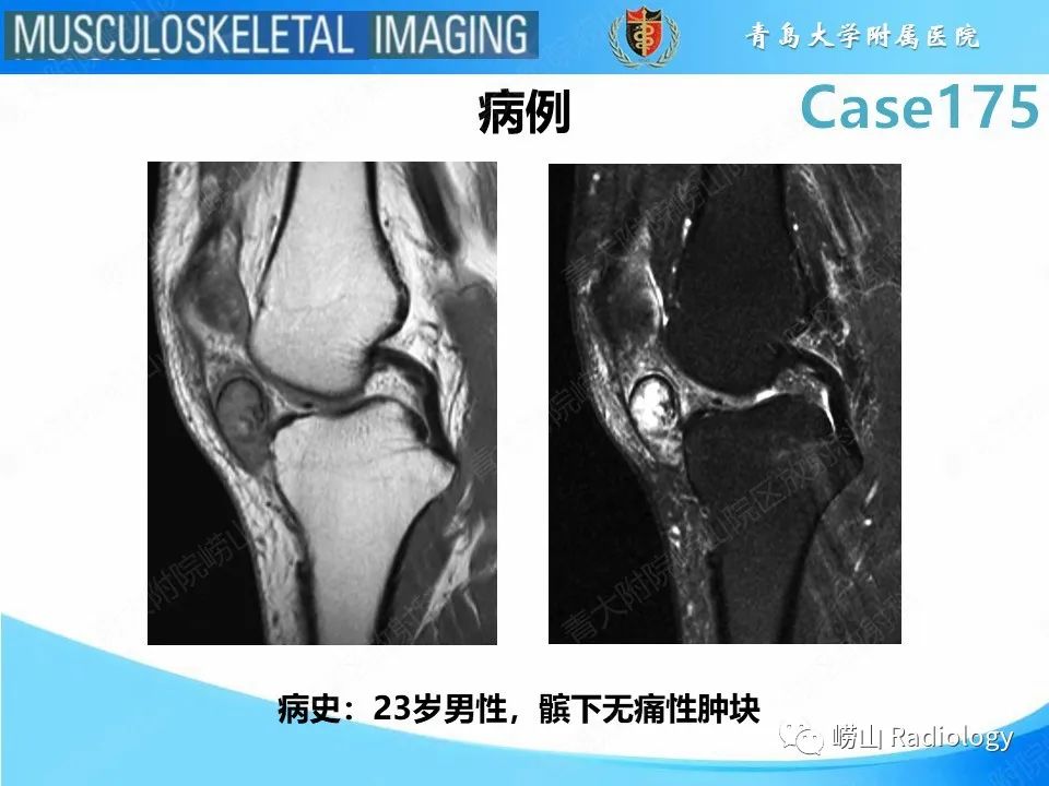 影像PPT - 【PPT】局灶性结节性滑膜炎-2