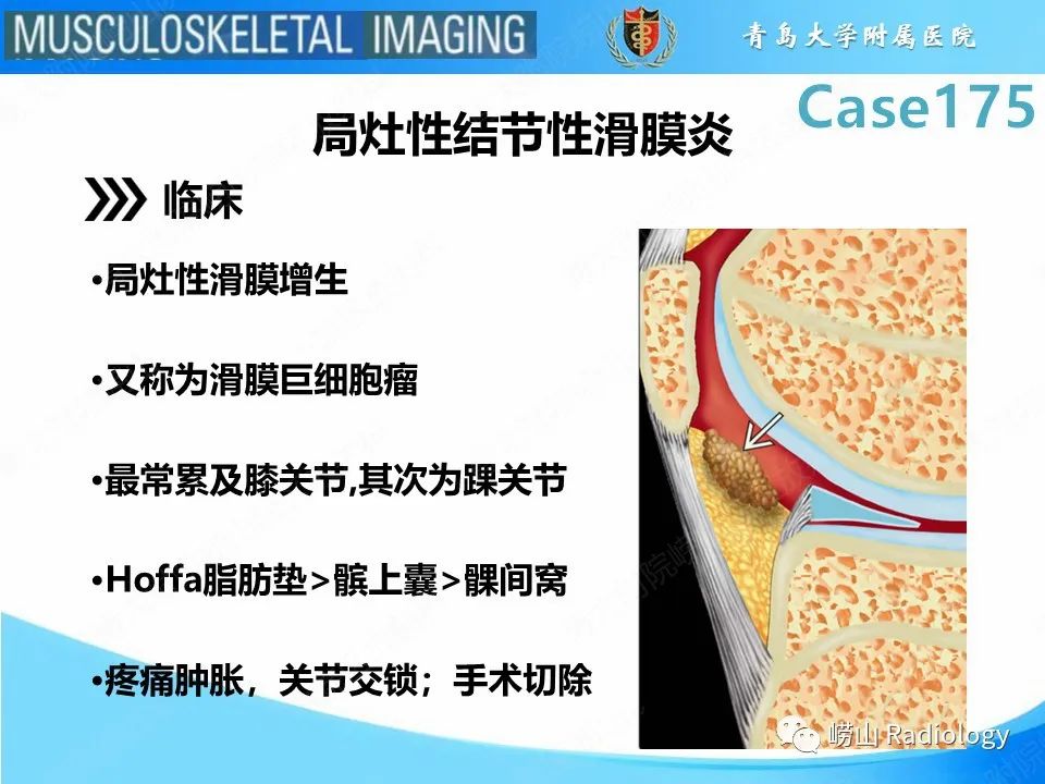 影像PPT - 【PPT】局灶性结节性滑膜炎-11