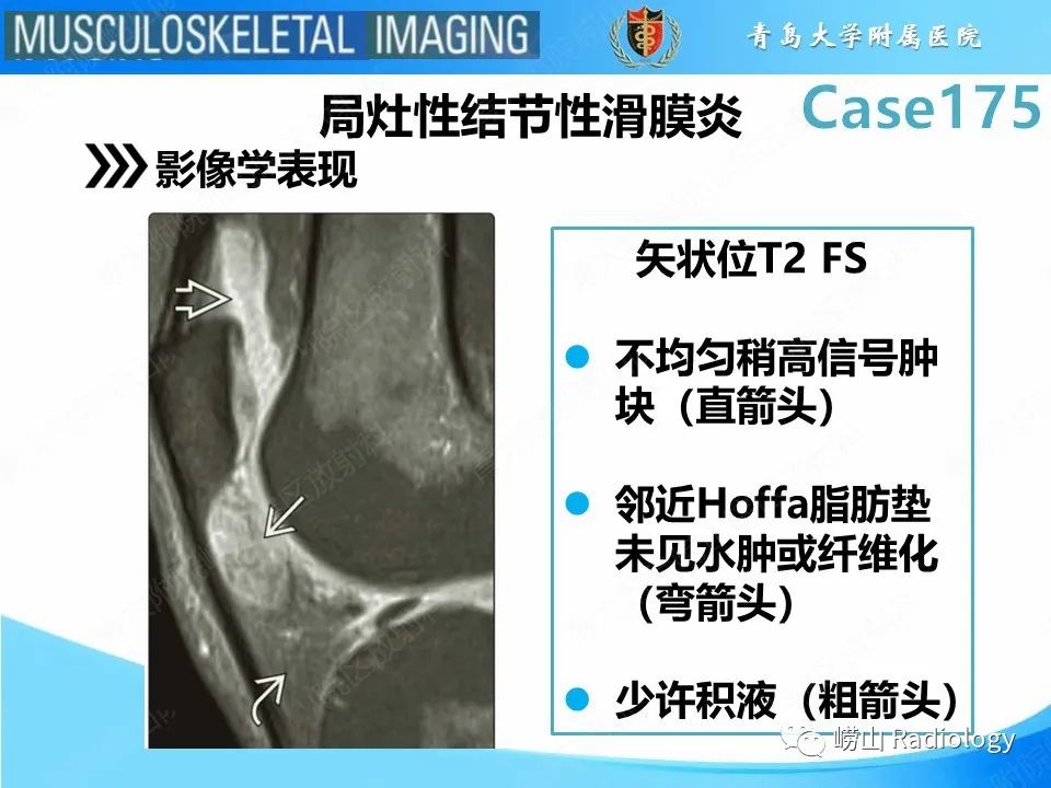 影像PPT - 【PPT】局灶性结节性滑膜炎-13