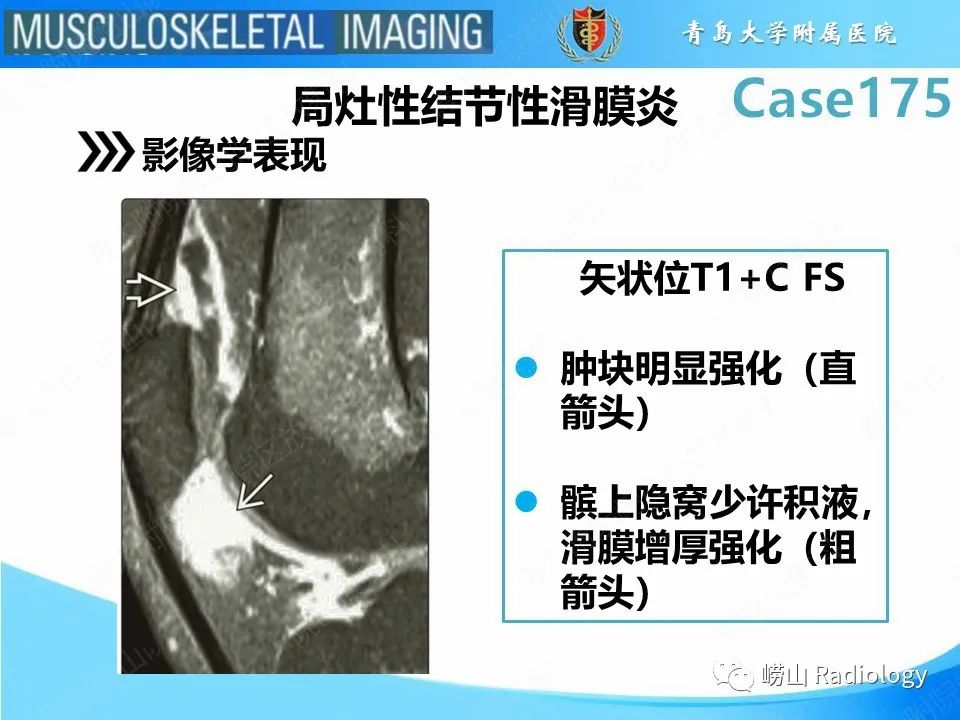 影像PPT - 【PPT】局灶性结节性滑膜炎-14