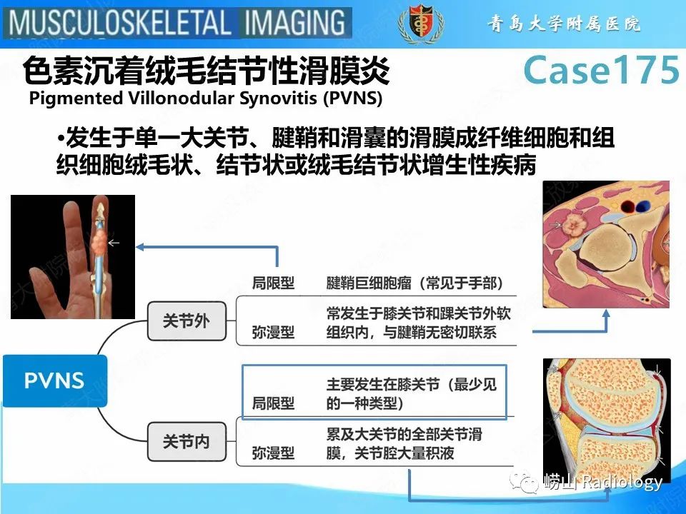 影像PPT - 【PPT】局灶性结节性滑膜炎-15