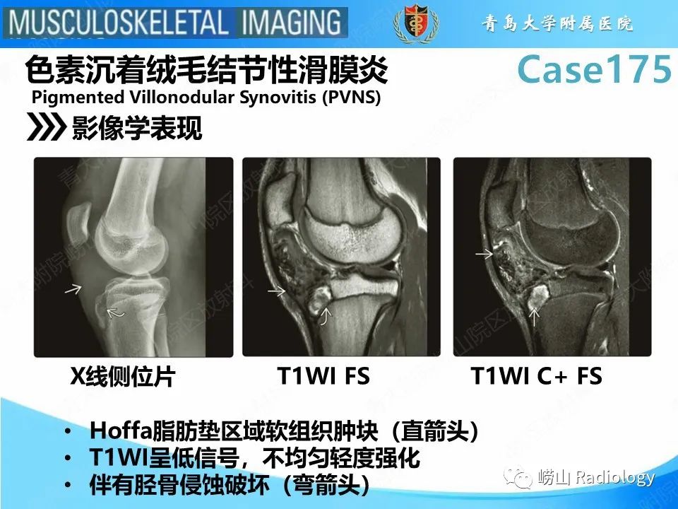 影像PPT - 【PPT】局灶性结节性滑膜炎-16
