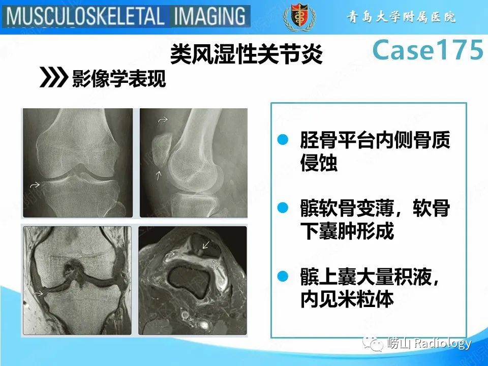 影像PPT - 【PPT】局灶性结节性滑膜炎-18