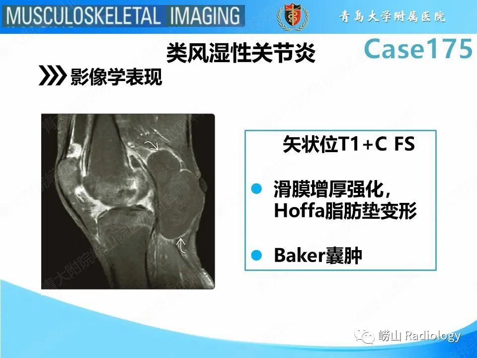 影像PPT - 【PPT】局灶性结节性滑膜炎-19