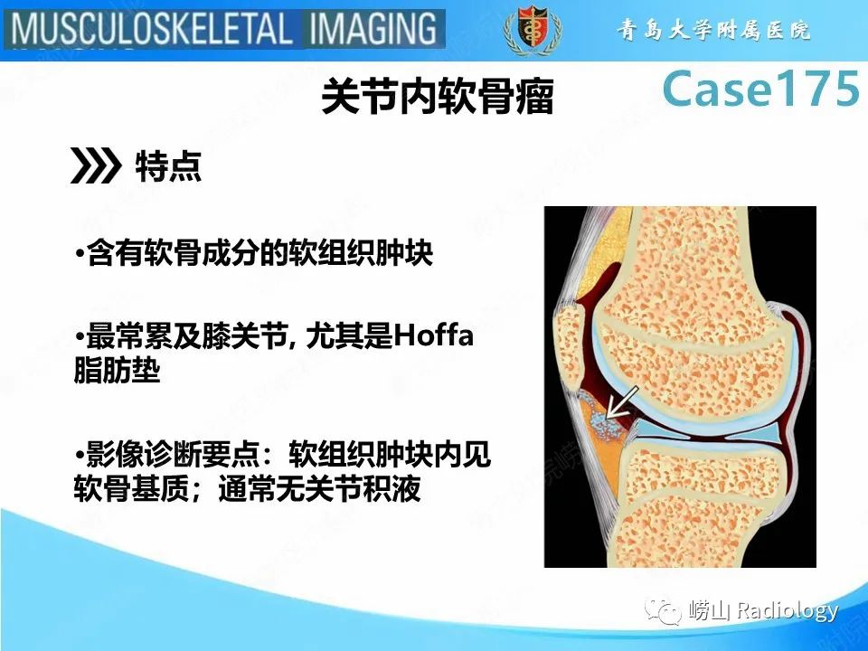 影像PPT - 【PPT】局灶性结节性滑膜炎-20