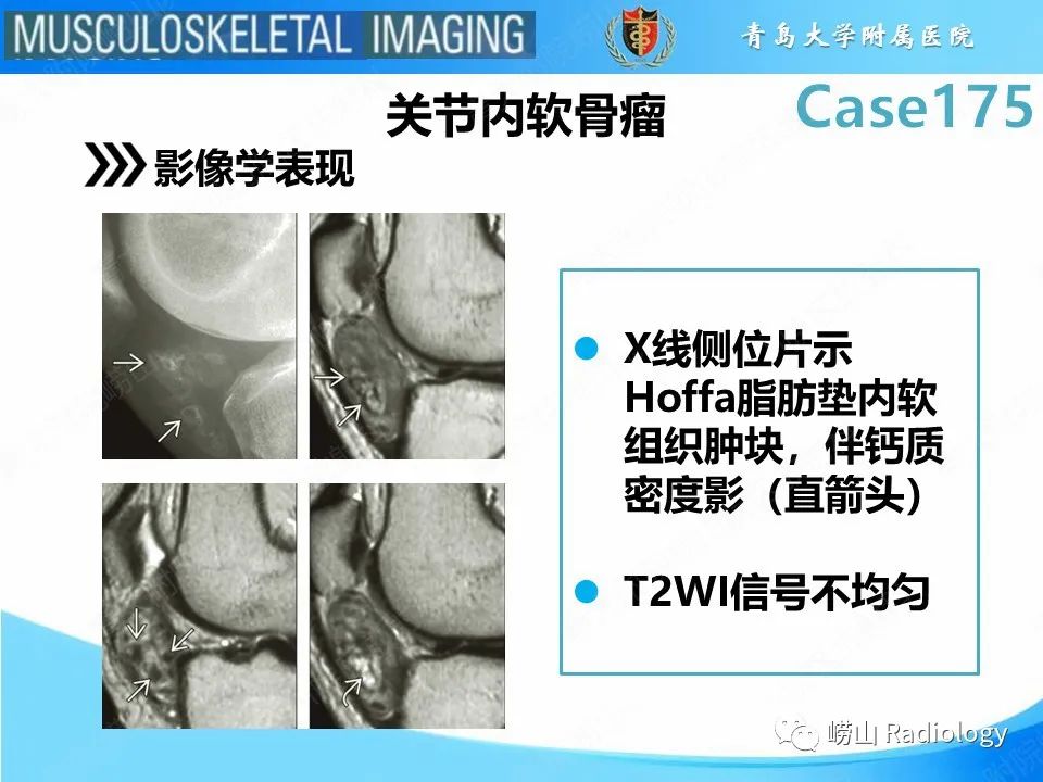 影像PPT - 【PPT】局灶性结节性滑膜炎-21