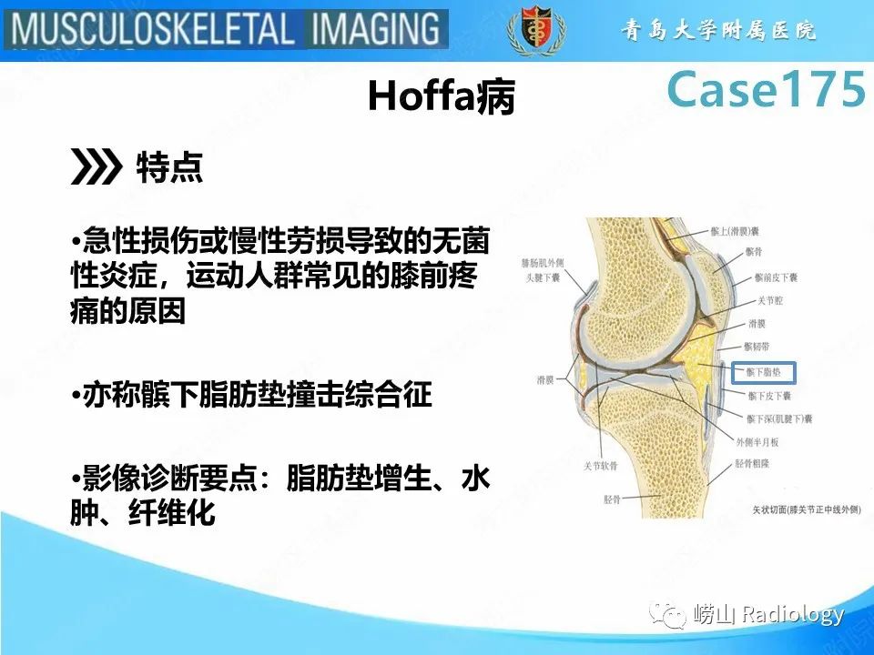 影像PPT - 【PPT】局灶性结节性滑膜炎-22