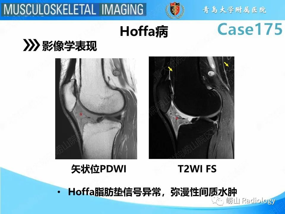 影像PPT - 【PPT】局灶性结节性滑膜炎-23