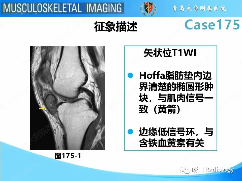 影像PPT - 【PPT】局灶性结节性滑膜炎-25