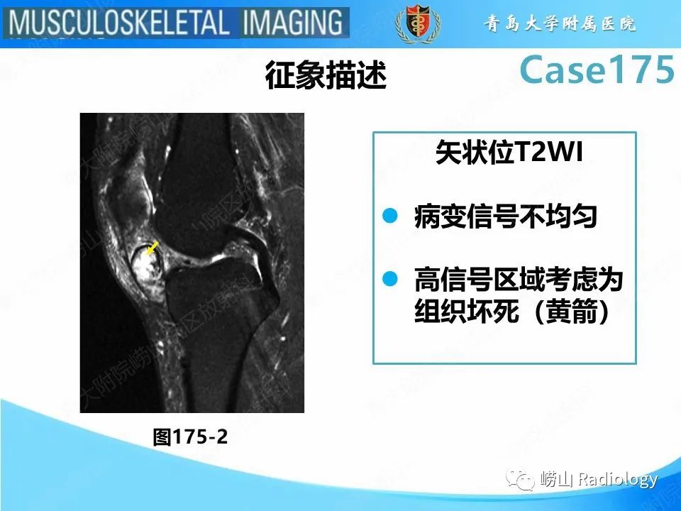 影像PPT - 【PPT】局灶性结节性滑膜炎-26