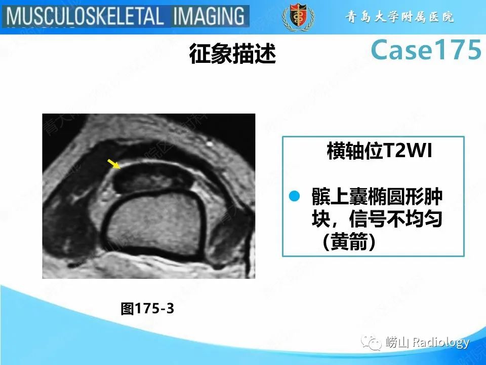 影像PPT - 【PPT】局灶性结节性滑膜炎-27