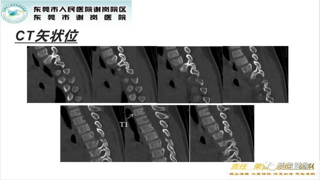 影像PPT - 【PPT】脊柱嗜酸性肉芽肿影像表现-4
