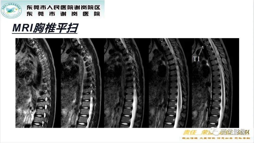 影像PPT - 【PPT】脊柱嗜酸性肉芽肿影像表现-5