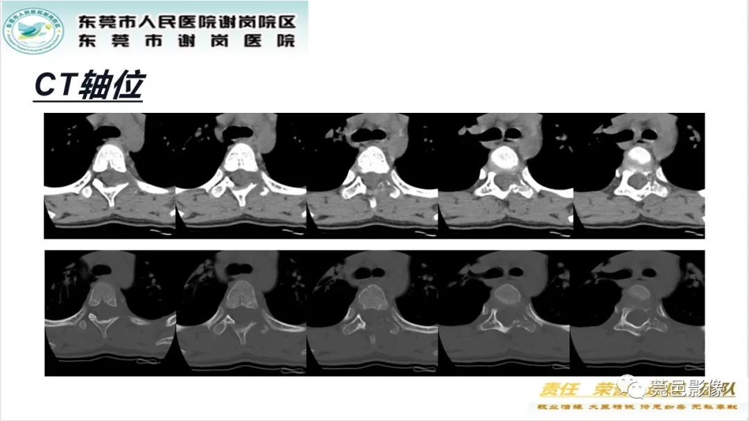 影像PPT - 【PPT】脊柱嗜酸性肉芽肿影像表现-3