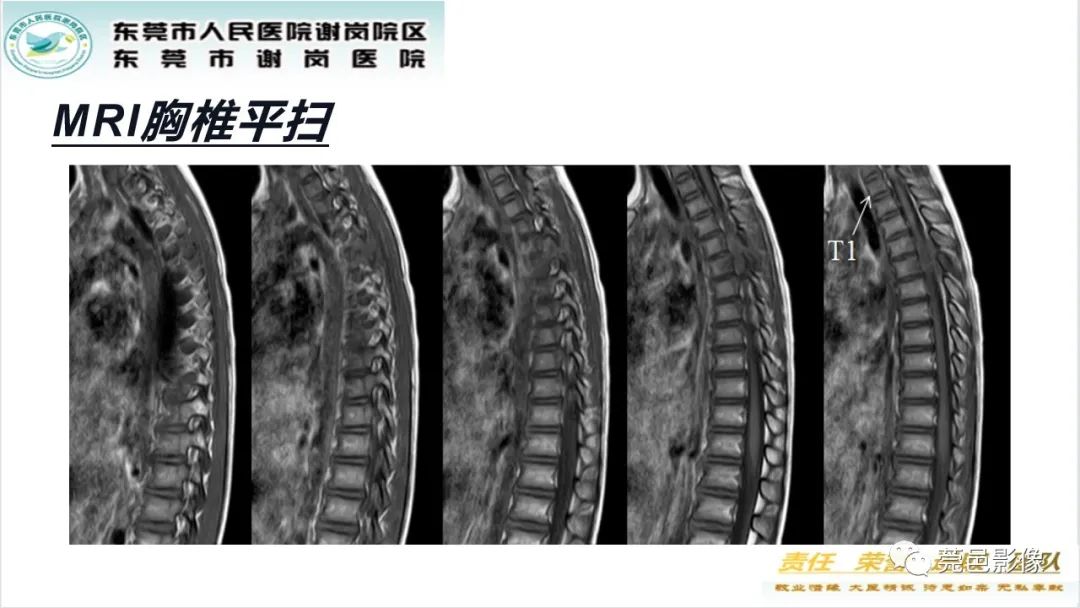 影像PPT - 【PPT】脊柱嗜酸性肉芽肿影像表现-6