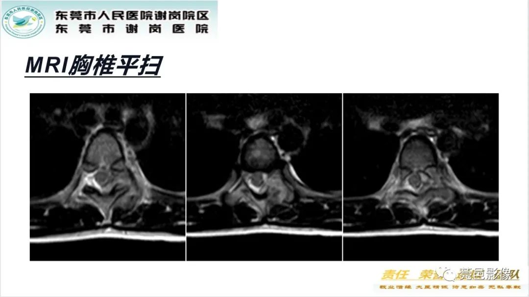 影像PPT - 【PPT】脊柱嗜酸性肉芽肿影像表现-7
