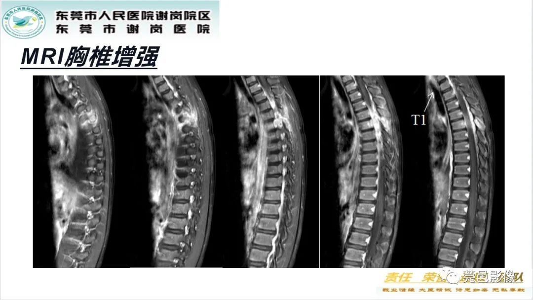 影像PPT - 【PPT】脊柱嗜酸性肉芽肿影像表现-8