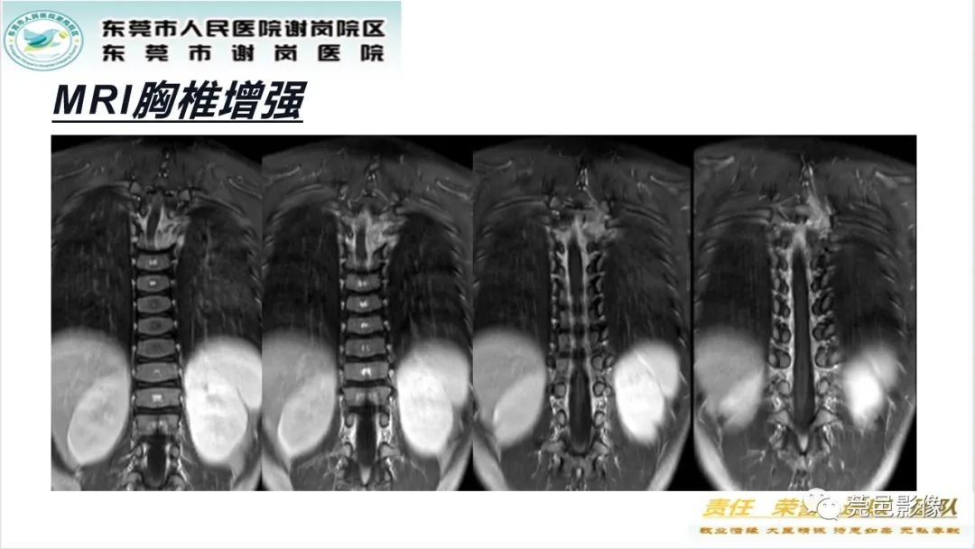 影像PPT - 【PPT】脊柱嗜酸性肉芽肿影像表现-9