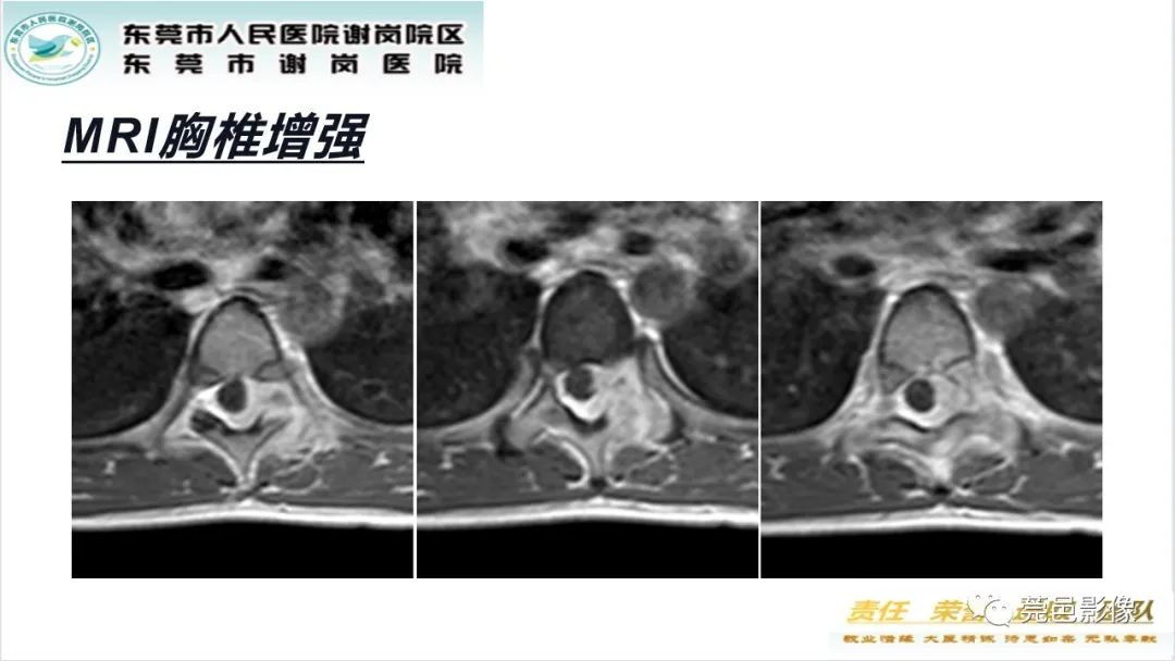 影像PPT - 【PPT】脊柱嗜酸性肉芽肿影像表现-10