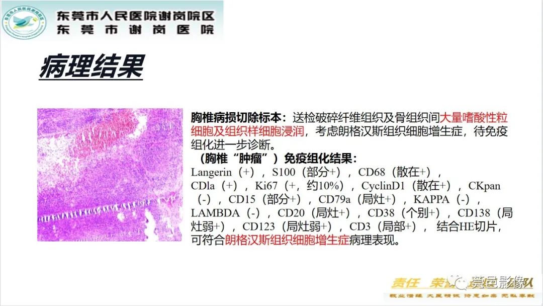 影像PPT - 【PPT】脊柱嗜酸性肉芽肿影像表现-13