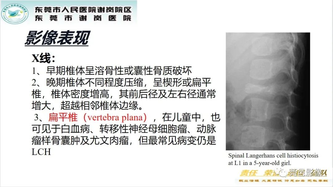 影像PPT - 【PPT】脊柱嗜酸性肉芽肿影像表现-18