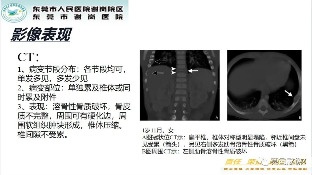 影像PPT - 【PPT】脊柱嗜酸性肉芽肿影像表现-19
