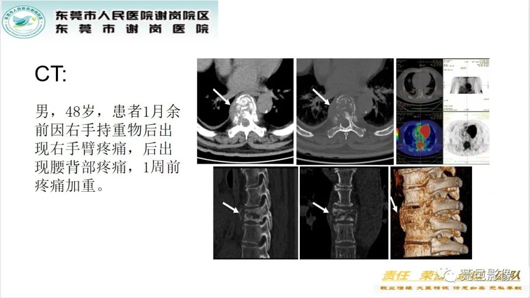 影像PPT - 【PPT】脊柱嗜酸性肉芽肿影像表现-20