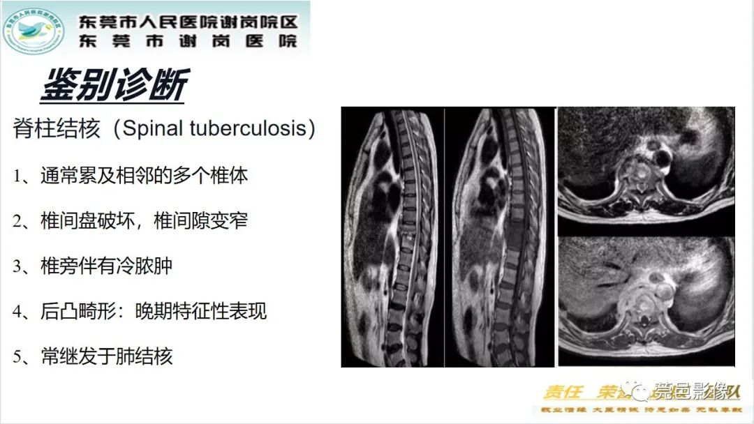影像PPT - 【PPT】脊柱嗜酸性肉芽肿影像表现-23