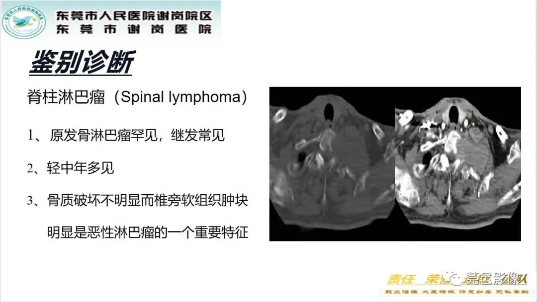 影像PPT - 【PPT】脊柱嗜酸性肉芽肿影像表现-24