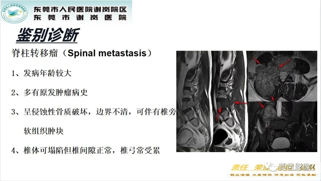 影像PPT - 【PPT】脊柱嗜酸性肉芽肿影像表现-25