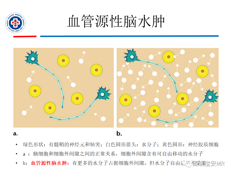 影像PPT - 【PPT】中毒性和代谢性脑病的影像模式-5