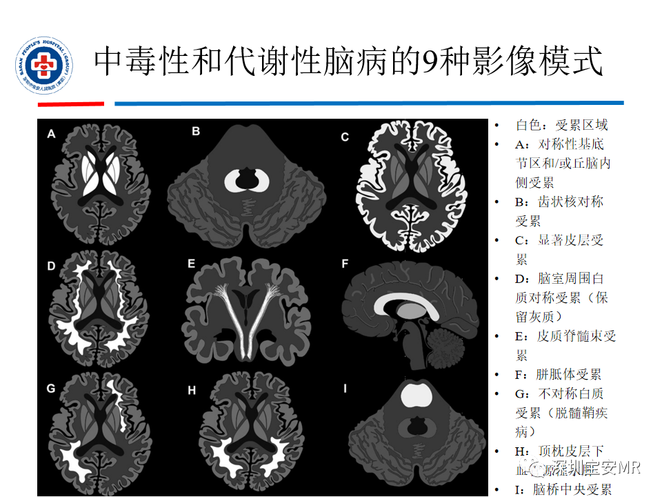影像PPT - 【PPT】中毒性和代谢性脑病的影像模式-10