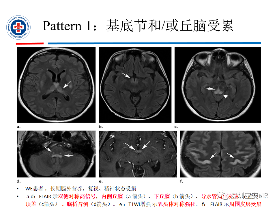 影像PPT - 【PPT】中毒性和代谢性脑病的影像模式-12