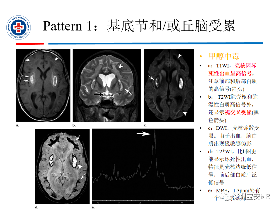 影像PPT - 【PPT】中毒性和代谢性脑病的影像模式-14