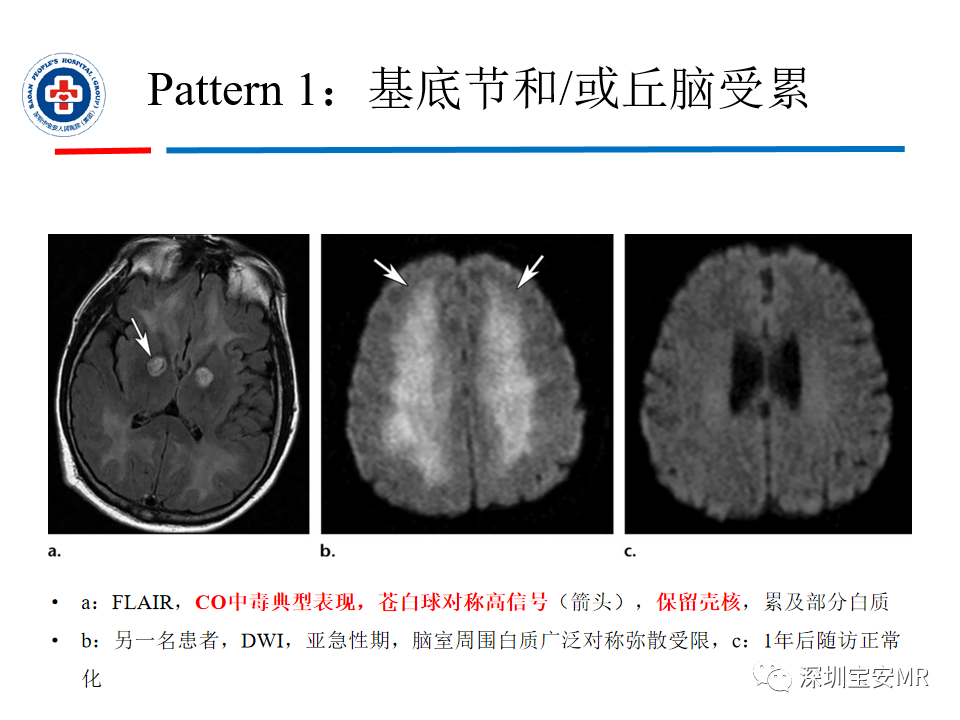 影像PPT - 【PPT】中毒性和代谢性脑病的影像模式-16