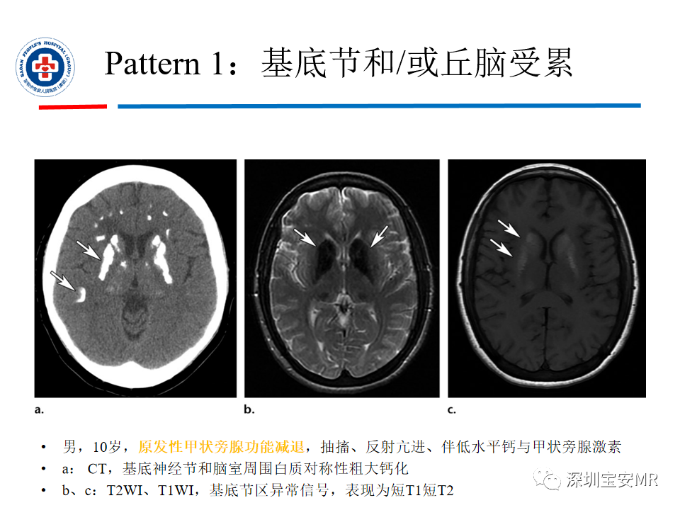 影像PPT - 【PPT】中毒性和代谢性脑病的影像模式-20