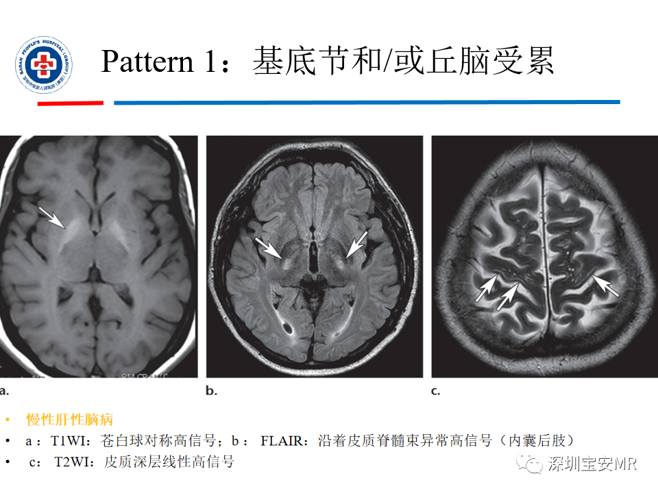 影像PPT - 【PPT】中毒性和代谢性脑病的影像模式-23