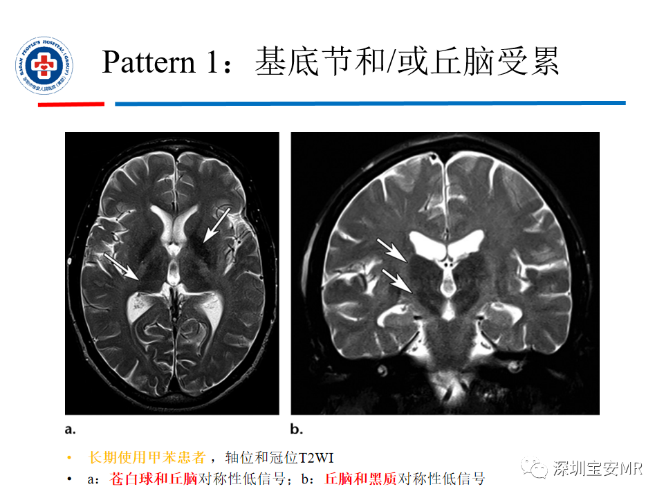 影像PPT - 【PPT】中毒性和代谢性脑病的影像模式-18